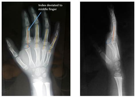 Kaplan’s Lesion : Complex Dorsal MCP joint dislocation | Epomedicine