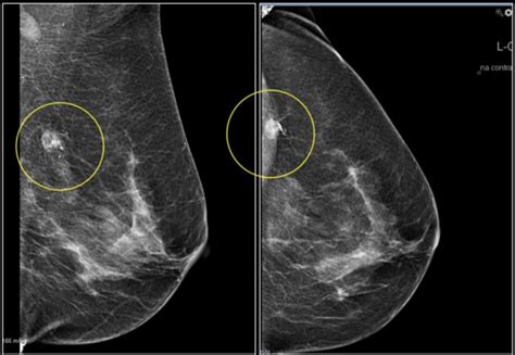 The Radiology Assistant : Bi-RADS for Mammography and Ultrasound 2013