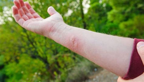 Identify & Treat Insect Bites & Stings | Australia Wide First Aid