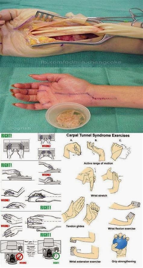 The Wealth of Health: Exercise to Prevent Carpal Tunnel Syndrome