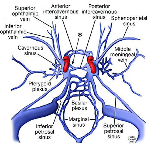 (PDF) Intercavernous Sinus Dural Arteriovenous Fistula Successfully Treated with Transvenous ...