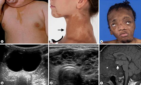 Figure 2 from The Clinical Spectrum of McCune-Albright Syndrome and Its Management | Semantic ...