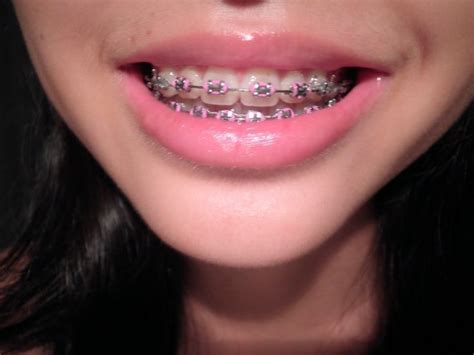 Pin by Myracle on Braces | Braces colors, Dental braces, Teeth braces