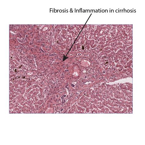 Pathology Glossary: Liver Cirrhosis | Draw It to Know It