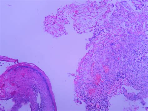 CHOLESTEATOMA – Histopathology.guru