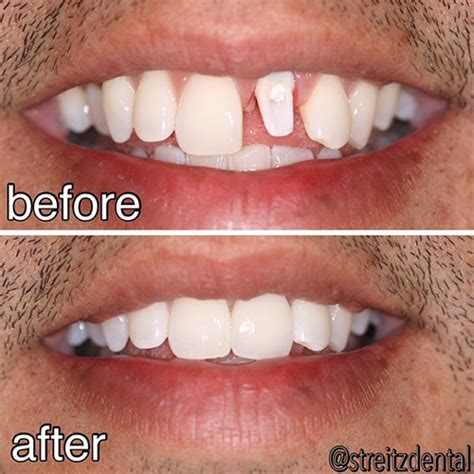 Before and After Photos of Dental Implants and Cosmetic Dentistry