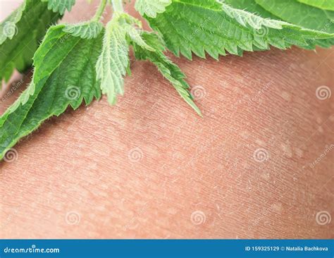 Plant Stinging Nettle Lying on Irritated Human Skin Covered with Small Wrinkles ,cracks and ...