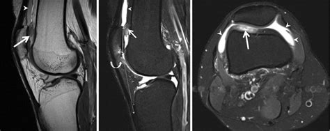 Mri Fat Pad Impingement Knee