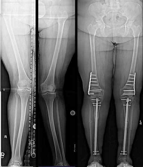 Can Knock Knees Be Corrected in Adults? | HSS