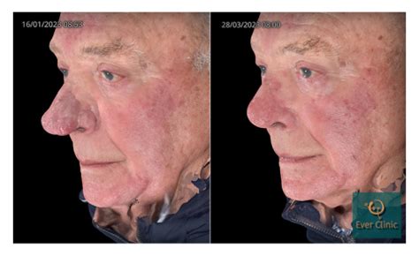 Rhinophyma Treatment Glasgow | Bulbous Nose Laser Surgery