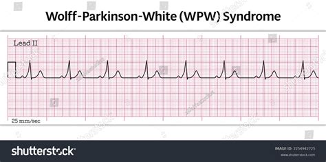 Antidrome Wpw 12 Kanal EKG