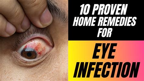 10 Proven Home Remedies for Eye Infection - YouTube