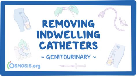 Genitourinary: Removing indwelling catheters: Video, Causes, & Meaning ...