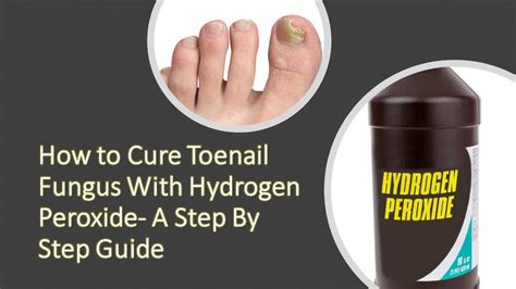 Toenail Fungus Vinegar Hydrogen Peroxide : Removal of Nail Fungi with ...