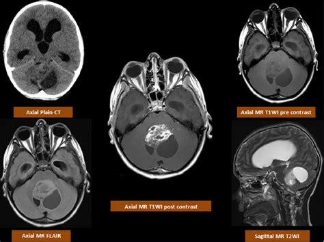 Posterior fossa tumors: clues to differential diagnosis with case-based review | Semantic Scholar