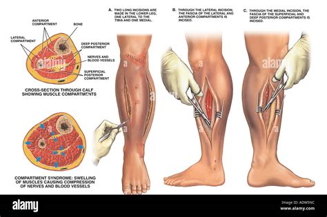 Compartment syndrome fasciotomy surgery hi-res stock photography and ...