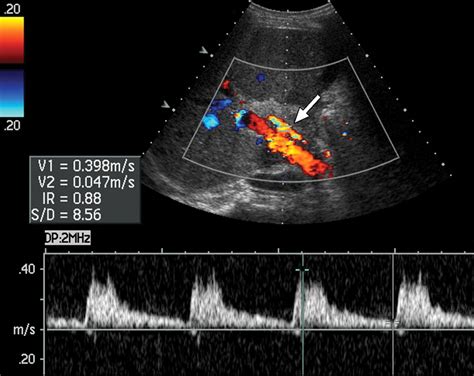 Hepatic Artery Ultrasound