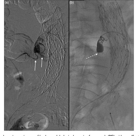 Figure 1 from Outcome and technical evolution of type 2 endoleak ...