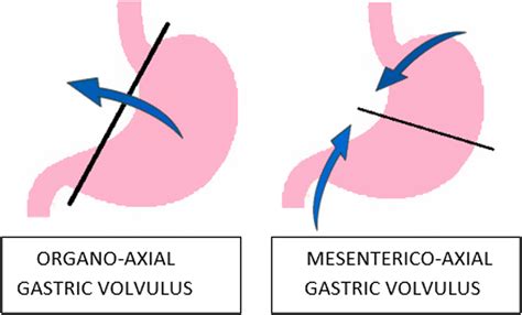 Volvulus