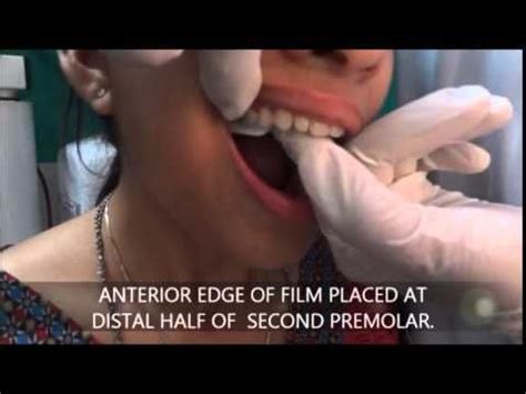 BISECTING ANGLE TECHNIQUE/ SHORT CONE TECHNIQUE | Dental hygiene school, Dental assistant study ...