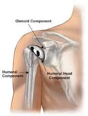 Knee Microfracture Surgery - Orthopedic Surgeon Monmouth County NJ | Marshall P. Allegra, M.D.