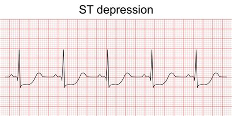 Angina ekg : 586 images, photos de stock, objets 3D et images ...