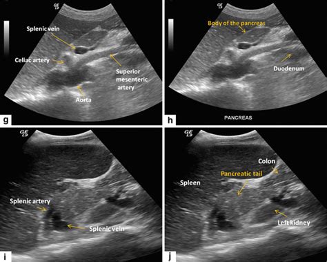 Pancreas Ultrasound Anatomy