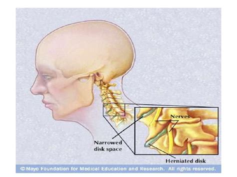 Cervical Spondylosis Syndrome