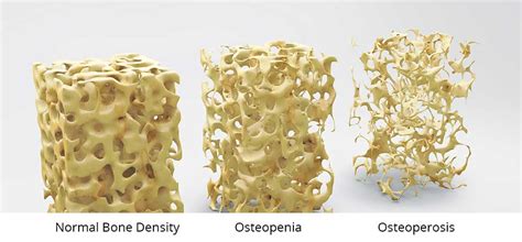 Bone Density Scan