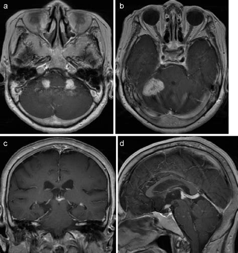 a: Initial T 1-weighted magnetic resonance imaging with gadolinium.... | Download Scientific Diagram