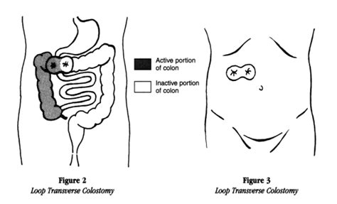 Colostomy Types | American Cancer Society