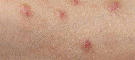 Skin Lesions: Meaning, Types Of Skin Lesions, Treatment, More - The ...