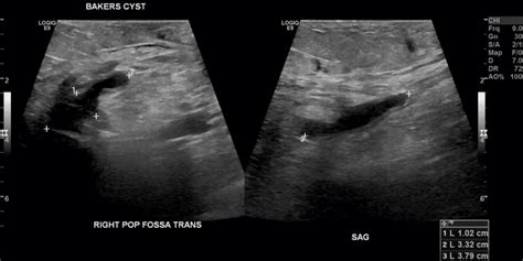 Baker's Cyst Hypermobility at Stacie Wood blog