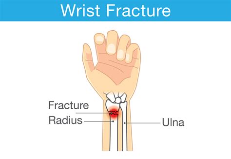 fractured wrist - First Aid Wiki