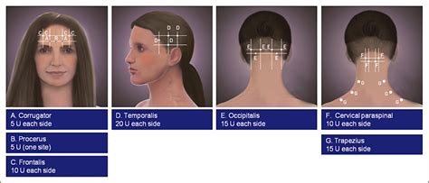 Method of Injection of OnabotulinumtoxinA for Chronic Migraine: A Safe, Well‐Tolerated, and ...