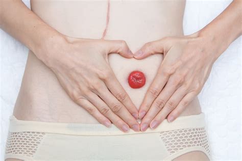 Stoma Care: How To Keep Your Stoma Clean and Healthy