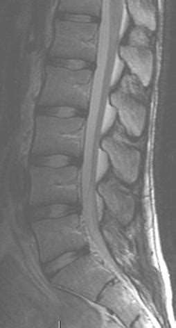 Spine Survey (MRI) - Los Angeles, CA | Cedars-Sinai