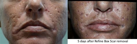 Ice Pick Excision - Acne Scars Excision Treatment Florida