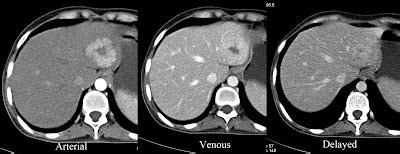 Radiodiagnosis - Imaging is Amazing-Interesting cases: Focal Nodular Hyperplasia of Liver - CT ...