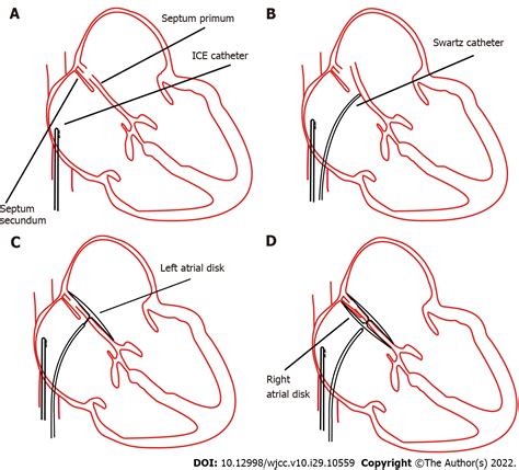 Novel way of patent foramen ovale detection and percutaneous closure by ...