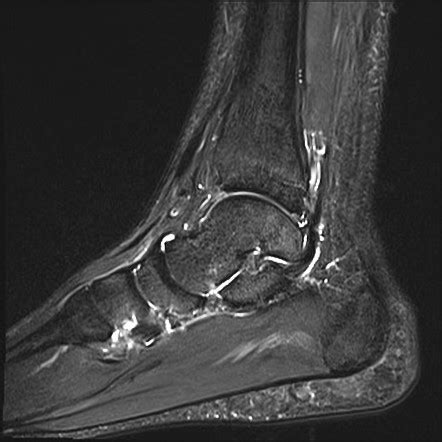 Ankle Impingement Syndrome