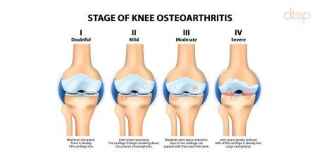 knee osteoarthritis Archives | Men's Health Singapore