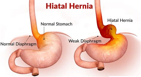 Hiatal Hernia - Causes, Symptoms, Diagnosis, Treatment and Surgery