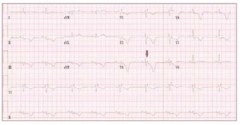 Absorb Medicine: Epsilon Waves in Arrhythmogenic Right Ventricular ...