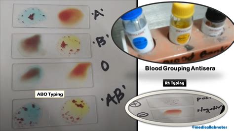 Blood Grouping and Rh Typing: Introduction, Principle, Procedure