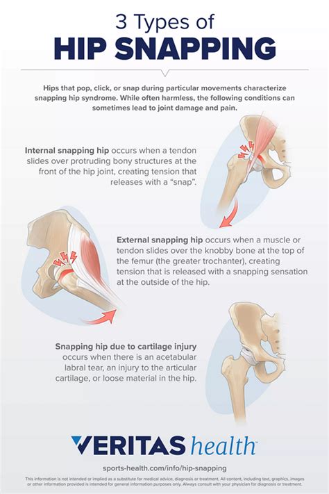 What is causing my hip to pop? – Fabalabse