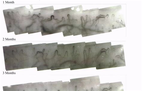 Nailfold capillaroscopy research in Raynaud’s | SRUK