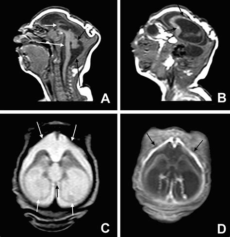 Clinical features and neuroimaging (CT and MRI) findings in presumed Zika virus related ...