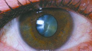 Get to Know Your Eye Lens Implant Options | Central Florida Health and ...