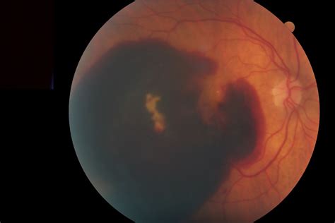 Macular Degeneration - The Retina Centers of Washington